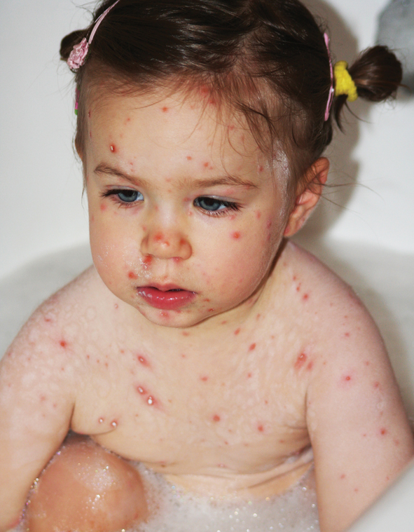 Chickenpox-Girl1440
