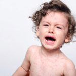 measles boy